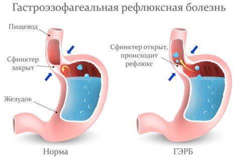 Развитие рефлюкс-эзофагита