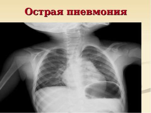 Возможно развитие пневмонии