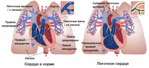 Опасное последствие патологии