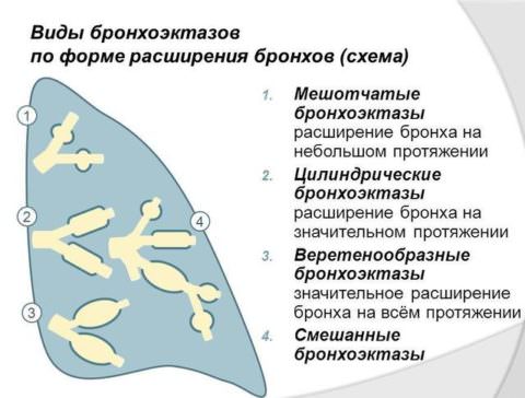 Виды деформации
