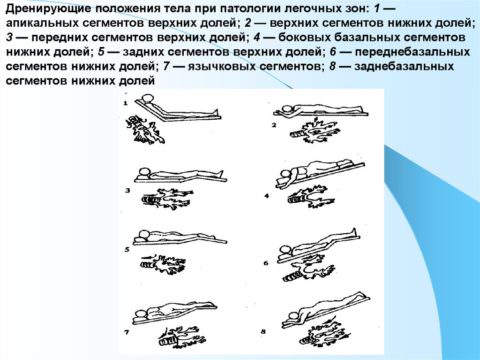 Дренирующее положение подбирается исходя из локализации гнойного очага