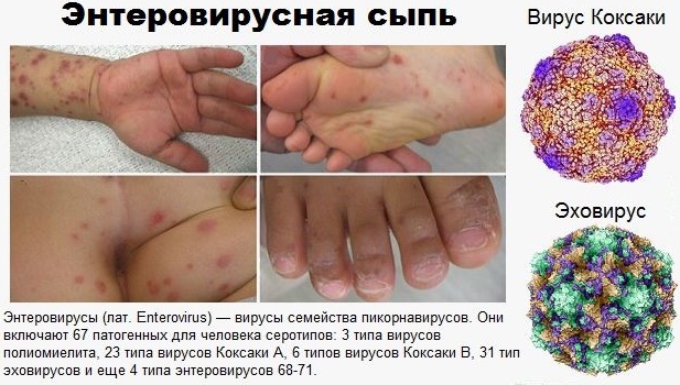 Энтеровирусы: типы, причины, симптомы