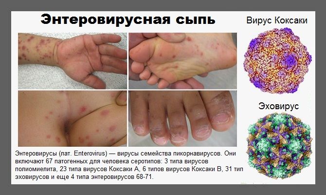 Энтеровирусы: типы, причины, симптомы