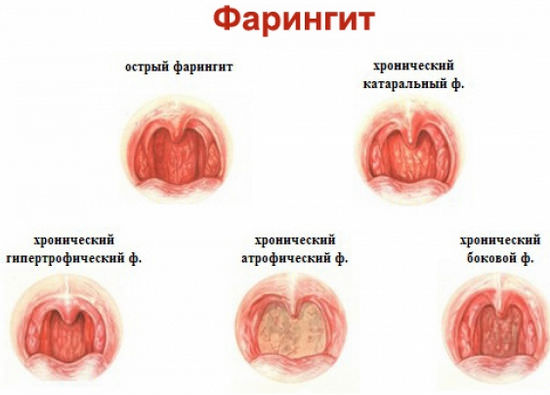 Фарингит: симптомы и лечение медикаментозное и народными средствами