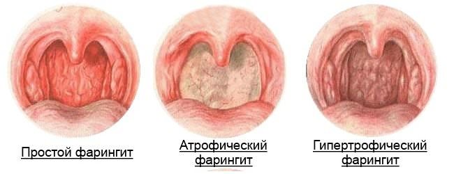 Фарингит: симптомы и лечение медикаментозное и народными средствами