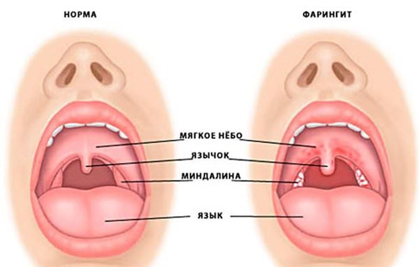 Фарингит: симптомы и лечение медикаментозное и народными средствами