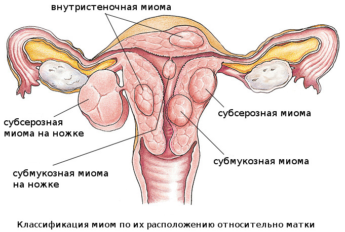 Фиброма матки — что это такое и чем опасна, симптомы и лечение