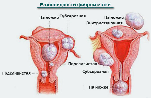 Фиброма матки — что это такое и чем опасна, симптомы и лечение