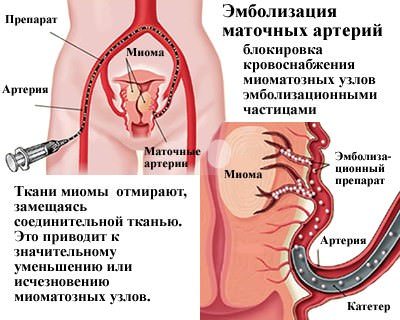 Фиброма матки — что это такое и чем опасна, симптомы и лечение