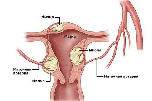 Фиброма матки — что это такое и чем опасна, симптомы и лечение