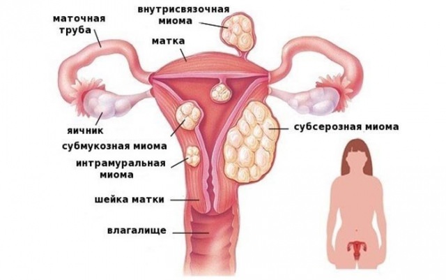 Фиброма матки — что это такое и чем опасна, симптомы и лечение